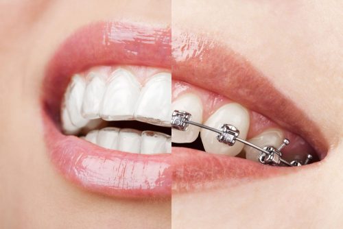 Affordable braces deals near me